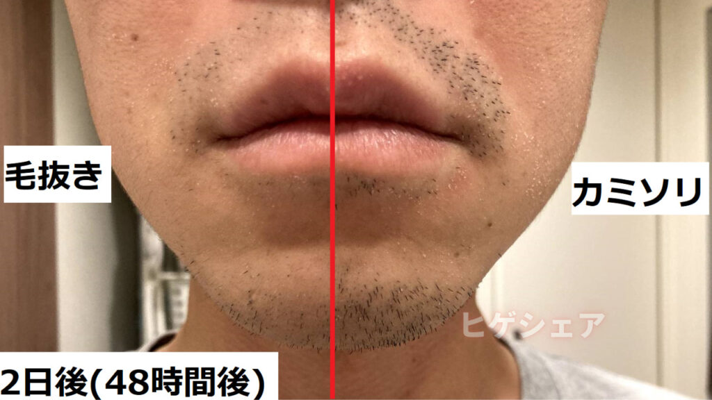 Plucking facial hair】ずっと見ていられる豊潤のヒゲ抜き 2018.8.25（鼻下ヒゲ⓵編）