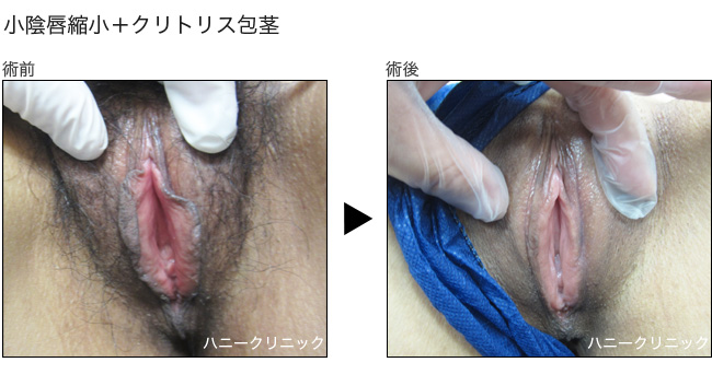 クリトリスを拡張・増大する方法｜簡単にできるクリ育の手順とは