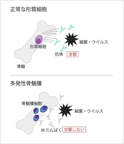 大学] 多発性骨髄腫の予後を悪化させる髄外病変がヒアルロン酸によって誘導される機序を解明し有効な治療法を開発 | お知らせ