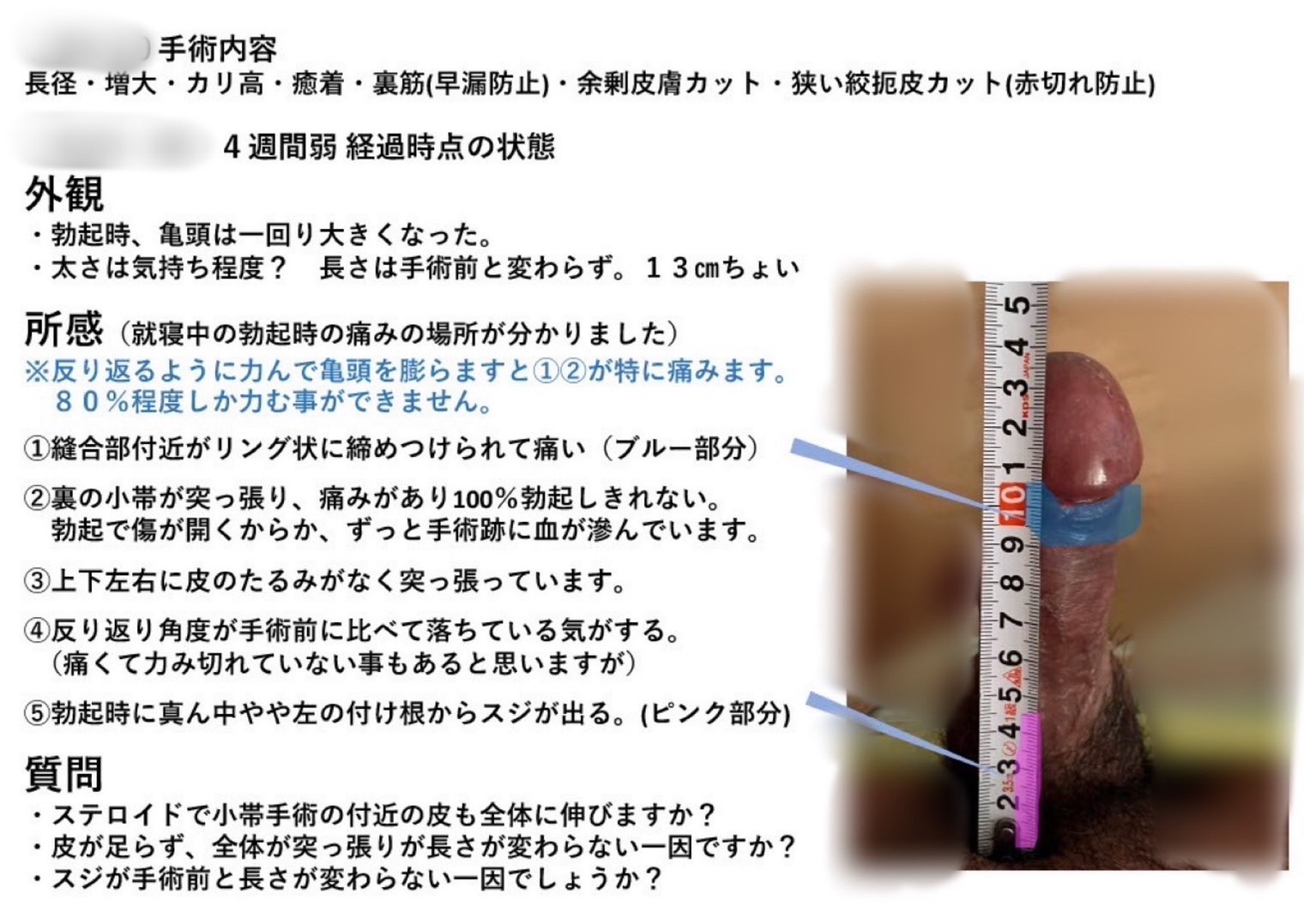 カリ高で立派な亀頭にする亀頭増大術の方法と効果について - ABCクリニックの包茎通信