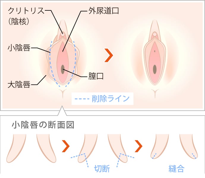 クリトリス包茎 | ゆかりレディースクリニック 神戸市三宮にある婦人科