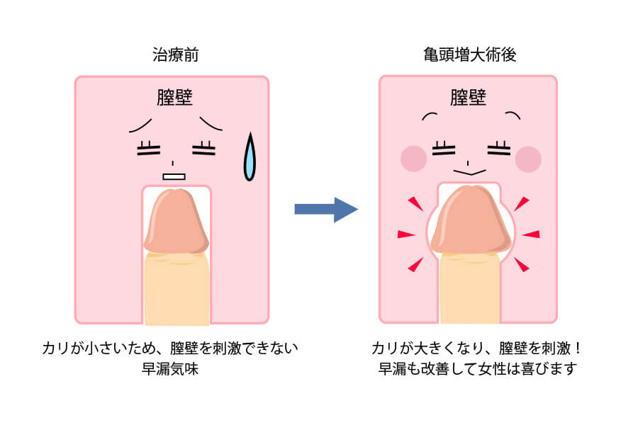 症例112 60代 陰茎増大術後のカリを高くする手術 |