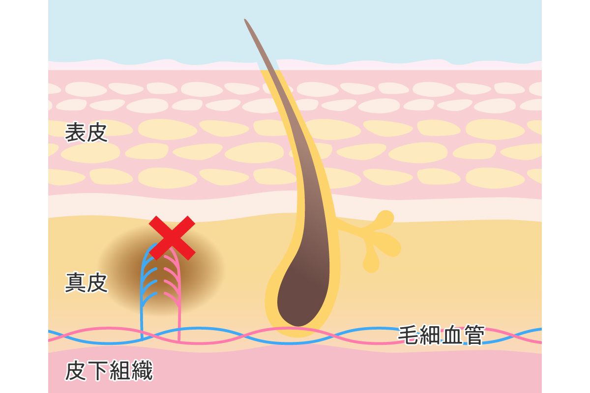 キスマークの消し方は？早く消す方法や緊急時の隠し方、上手な言い訳を解説