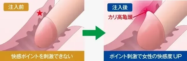 【手術密着】亀頭増大で早漏を改善してカリ高になりたい