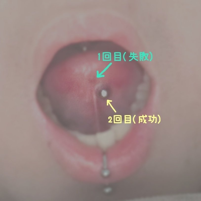 クリアクリーン プラス 薬用デンタルリンス｜クリアクリーン他、1商品を使った口コミ - 舌ピ(センタータン)を開けたので、開け方と経過のレポです。