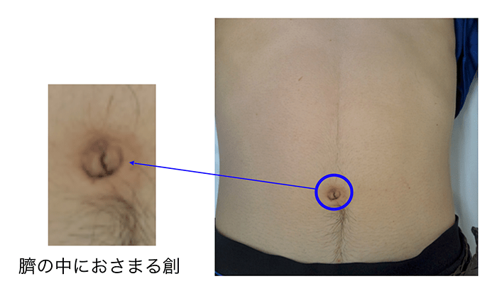 グロインペイン症候群 （鼠径部痛症候群） | 西宮市の整体【痛くない施術】あいば健整院