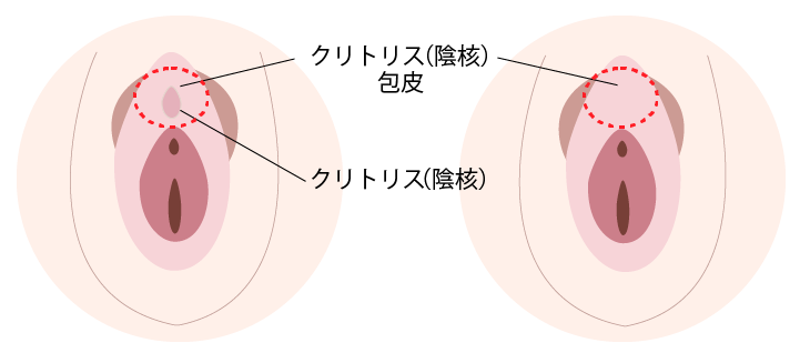 こんにちは！中村桜子です！ 「クリトリス包茎」って聞いたことはありますか？ 実は男性だけではなく女性にも ・真性包茎 ・仮性包茎