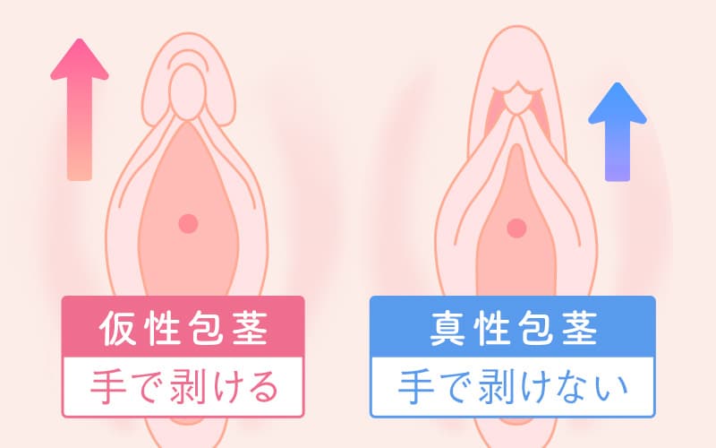 図解画像】クリトリスの皮を剥くべきか？剥かないべきか？正しい皮の剥き方とは？ - sexprogress.com