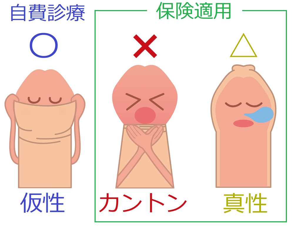 泌尿器科の専門医が徹底解説】包茎の全４種類とそれぞれのリスク・治療必要レベルを紹介