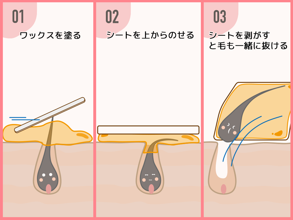 ブラジリアンワックス脱毛の仕組み・原材料・成分を徹底図解！ | アンジェリカ コラム