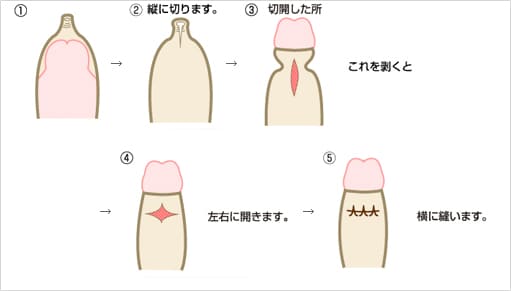 泌尿器科の専門医が徹底解説】包茎でセックスする6つのリスク