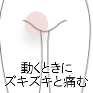 医師に相談】恥骨結合炎（恥骨炎）とはどのような病気ですか？ | ライフスタイル