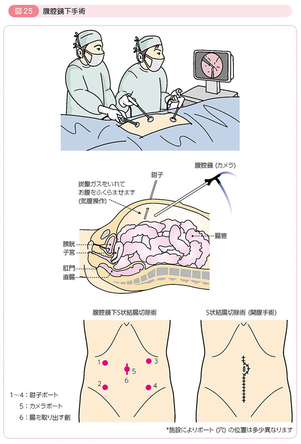 s字結腸拡張器具